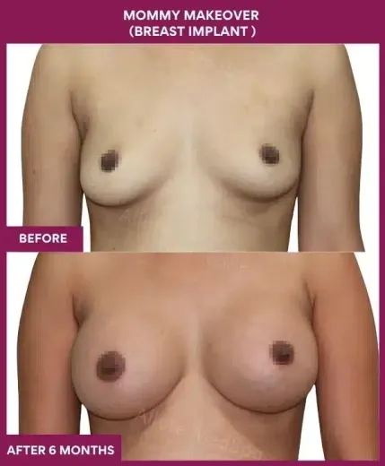 5 Mommy Makeover (Breast implant )_25 (2)