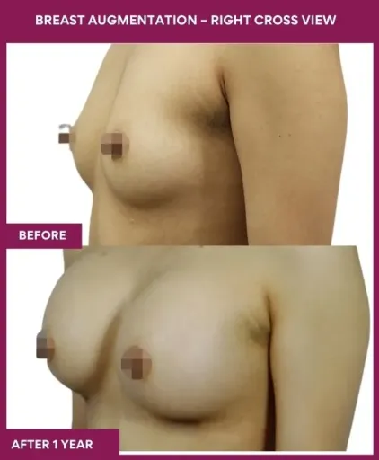 7 Breast Augmentation – Right Cross View_20
