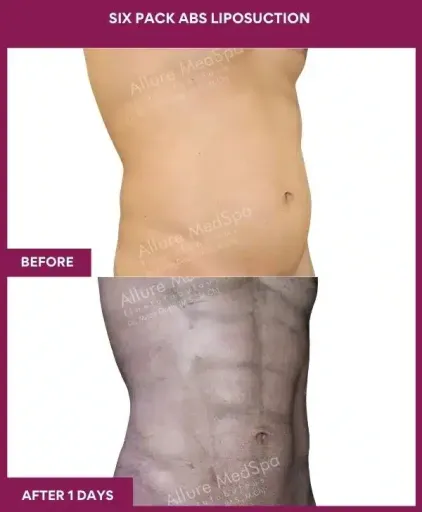 8- Six Pack Abs Liposuction--