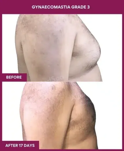 9-GYNAECOMASTIA GRADE 3 (2)_
