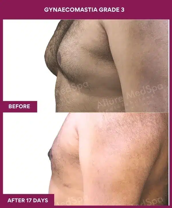 9-GYNAECOMASTIA GRADE 3 (3)_