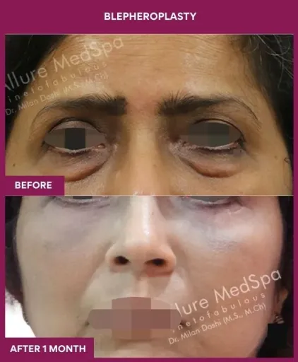 1 BLEPHEROPLASTY (3)_3_