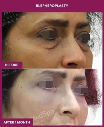 1 BLEPHEROPLASTY (4)_3_