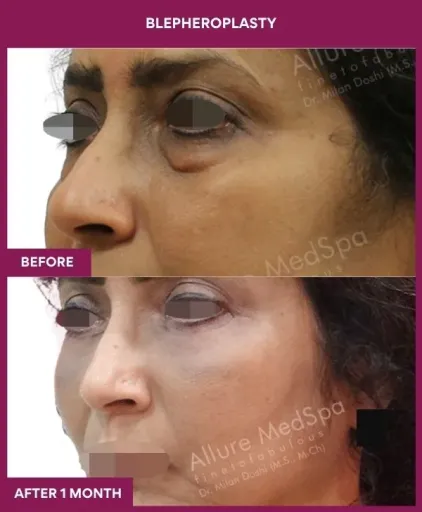 1 BLEPHEROPLASTY (5)_3_