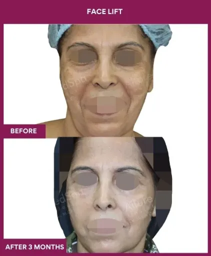 10 FACE LIFT (4)_22_