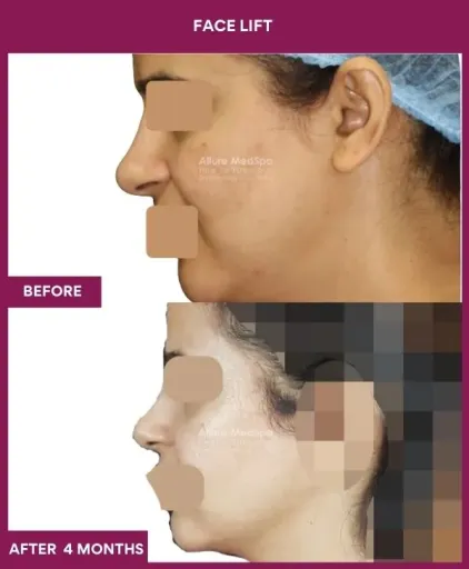 12 FACE LIFT_29_ (2)