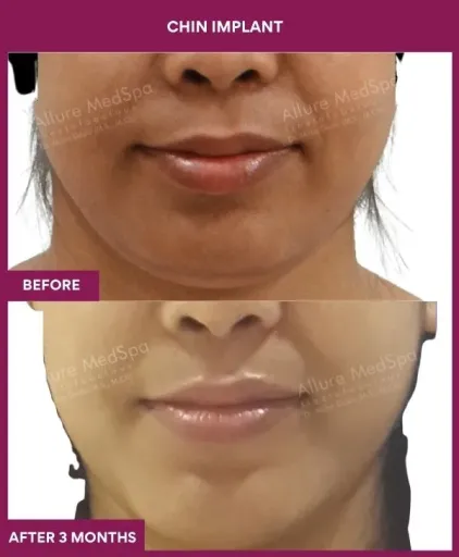 13 Chin Implant (4)_36