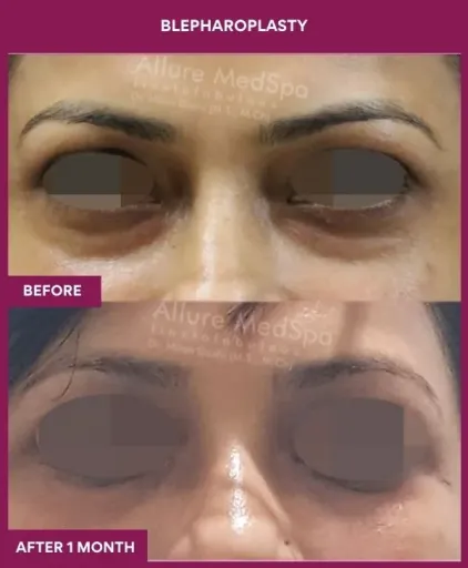 2 Blepharoplasty (2)_4_