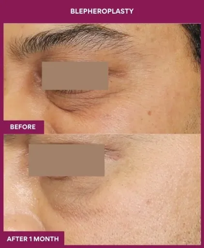 3 BLEPHEROPLASTY (5)_7_