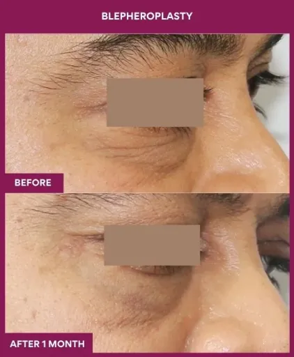 3 BLEPHEROPLASTY (7)_7_