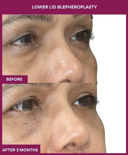 LOWER LID BLEPHEROPLASTY Surgery In Mumbai, India