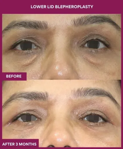 LOWER LID BLEPHEROPLASTY Surgery In Mumbai, India
