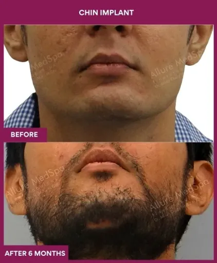6 Chin Implant (4)_17