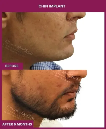 6 Chin Implant (5)_17