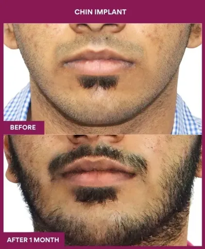 7 Chin Implant (4)_20_