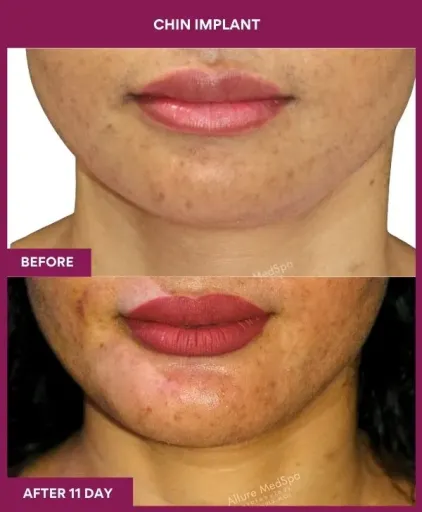 8 Chin Implant (4)_23_