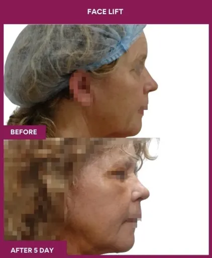 9 FACE LIFT_20_ (2)