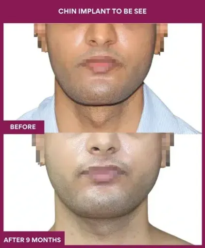 chin implant surgery in mumbai