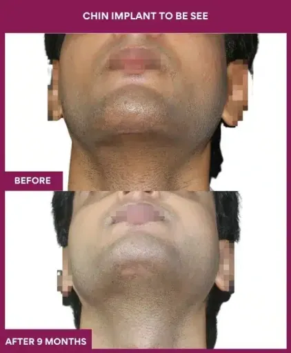 chin implant surgery in mumbai