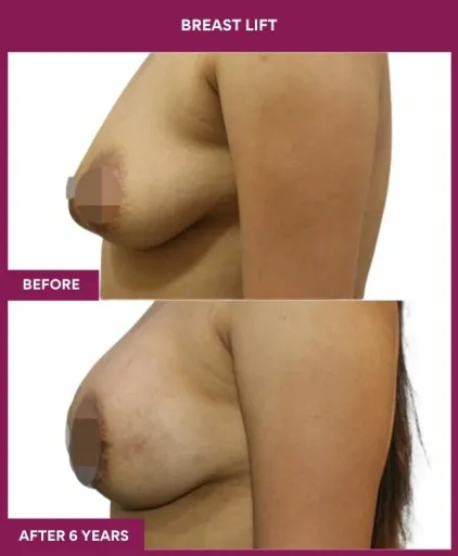 2 breast lift (3)