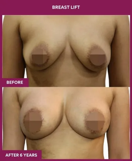 2 breast lift