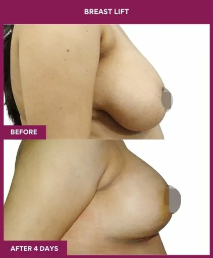 3 breast lift (2)