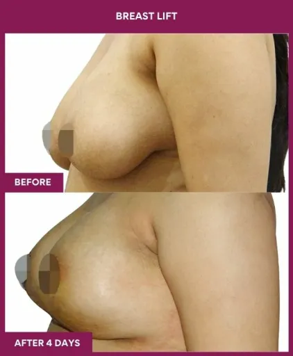 3 breast lift (3)