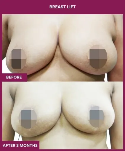 4 breast lift