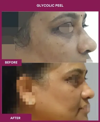 Glycolic Peel Result in Mumbai