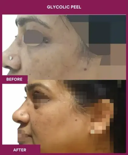 Glycolic Peel Result in Mumbai