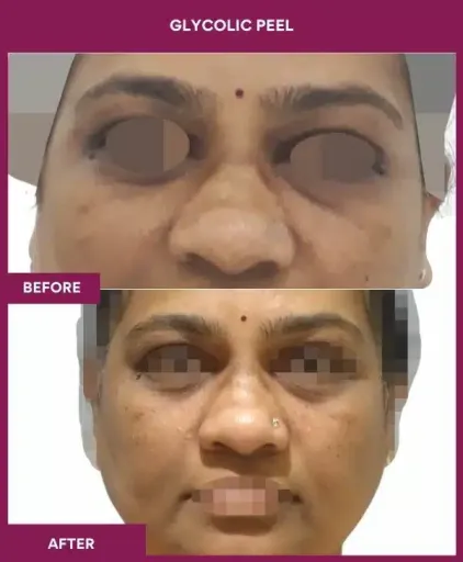 Glycolic Peel Result in Mumbai