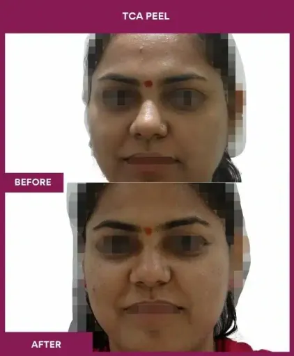 10 TCA Peel