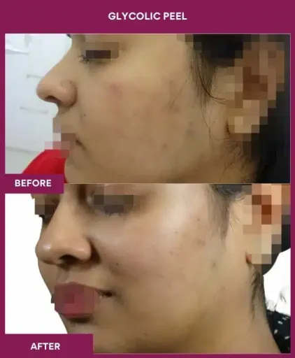 Glycolic Peel Before After Images in Mumbai