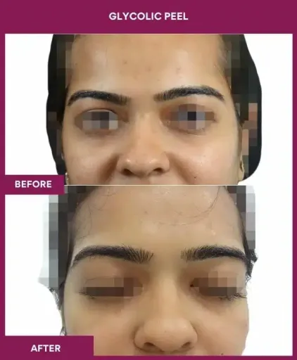 Glycolic Peel Before After Images in Mumbai