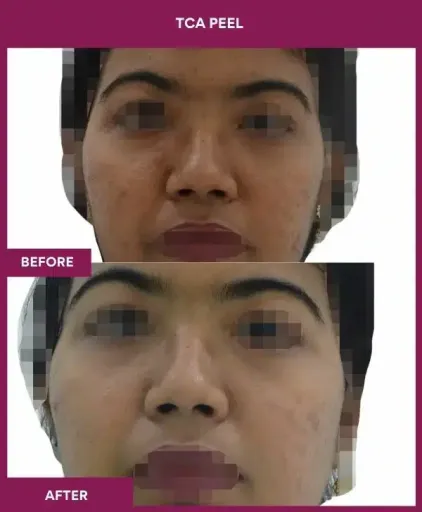 11 TCA Peel