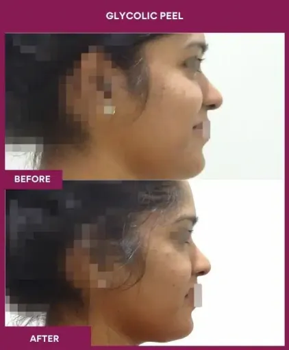 Glycolic Peel Before After Photos