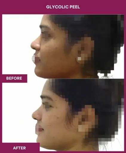 Glycolic Peel Before After Photos