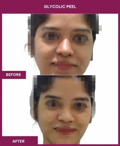 Glycolic Peel Before After Photos