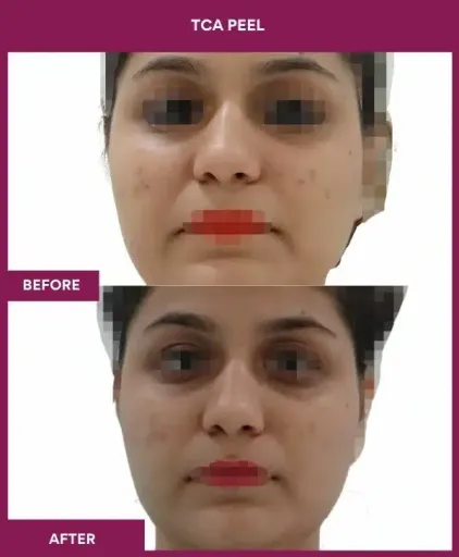 12 TCA Peel
