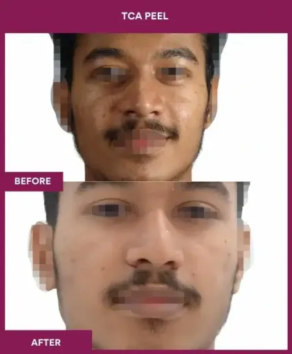 13 TCA Peel