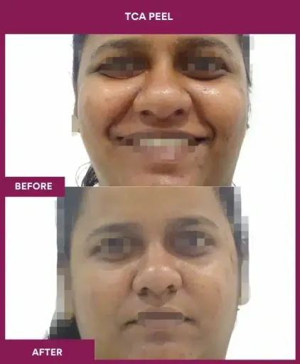 15 TCA Peel