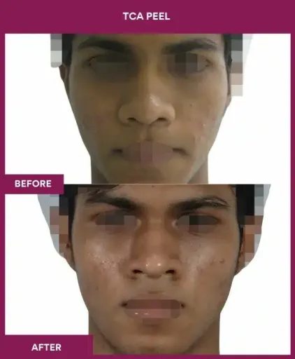 16 TCA Peel
