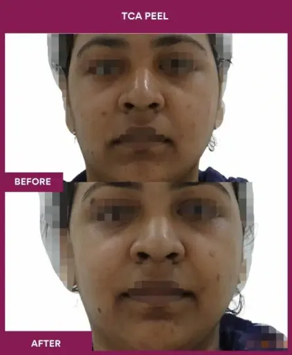 17 TCA Peel