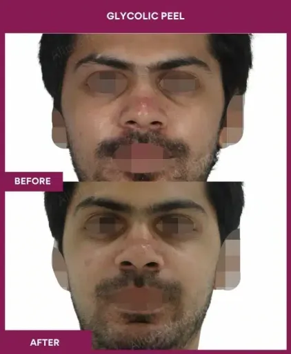 Male Glycolic Peel in Mumbai, India