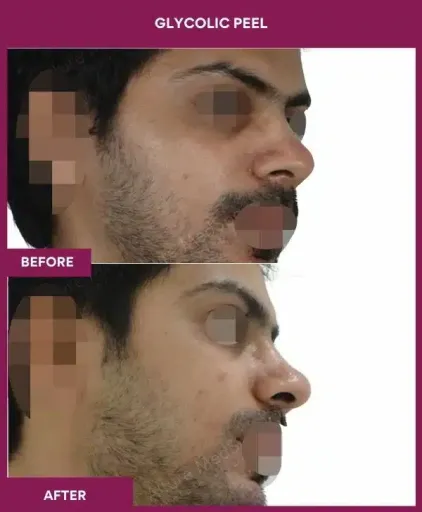 Male Glycolic Peel in Mumbai, India
