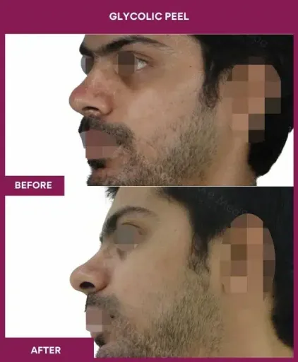 Male Glycolic Peel in Mumbai, India