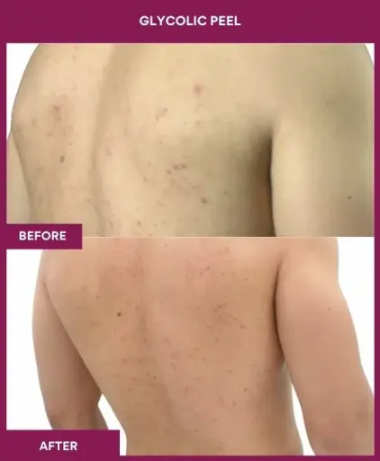 Back Glycolic Peel Treatment in Munbai