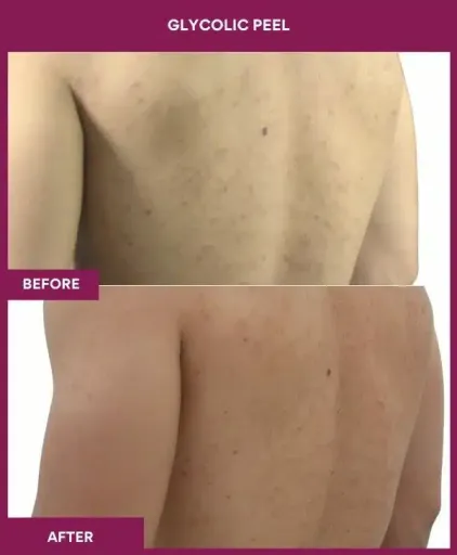 Back Glycolic Peel Treatment in Munbai