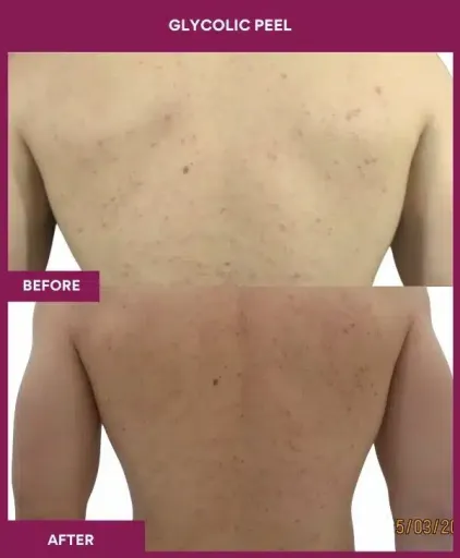 Back Glycolic Peel Treatment in Munbai