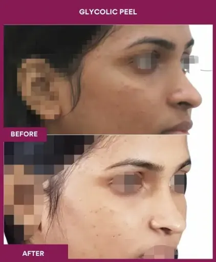 Female Glycolic Peel in Mumbai